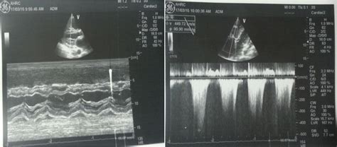 Figure 1 From Triology Of Fallot Presenting With Isolated Pulmonary Valve Infective Endocarditis