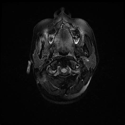 Trigeminal Schwannoma Image Radiopaedia Org