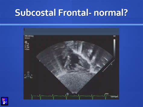 The above subcostal view is not normal- It is Transposition of the ...