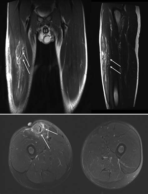 Rectus Femoris Strain Symptoms