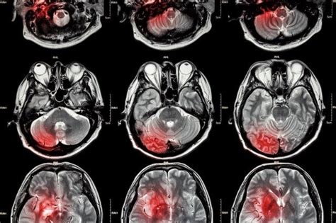 Cientistas Descobrem Como As Les Es Cerebrais Ativam As C Lulas