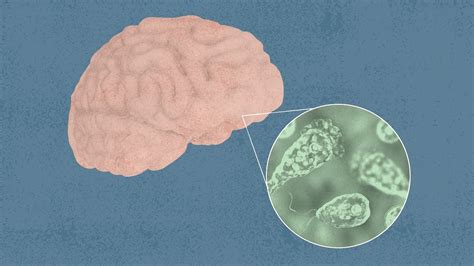 Man Infected With Brain Eating Amoeba After Visiting Iowa Beach