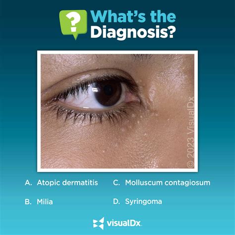 Check Out These Eyelid Growths And See If You Know The Dx Visualdx