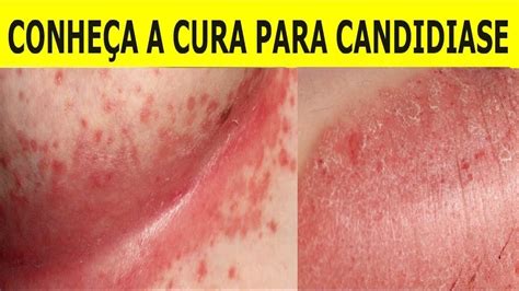 Candidíase o que é sintomas como tratar e tem cura Health SexiezPicz