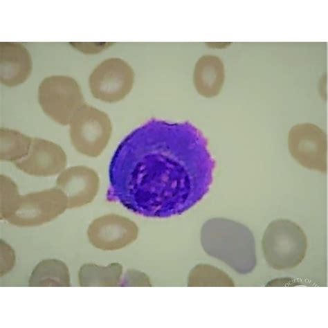 Flame Cells in Plasma Cell Leukemia