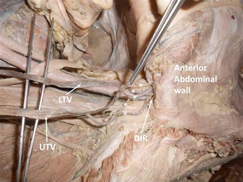 Dissection of the lower part of the abdomen near the deep inguinal ...