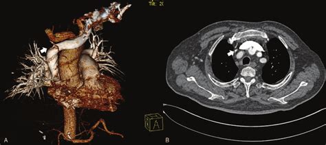 Preoperative Ct Chest Angiography A 3d Reconstruction Of Major Chest