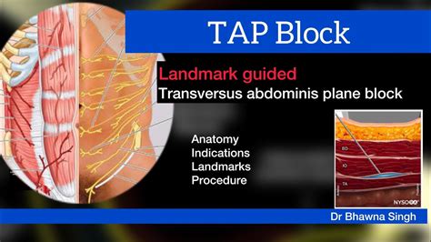 Landmark Guided Transversus Abdominis Plane Tap Block In Easy Way