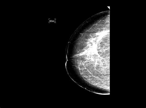 Mammography Mammography Artifacts