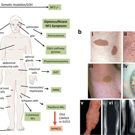 Gene NF 1 localised at 17q11.2 | Download Scientific Diagram