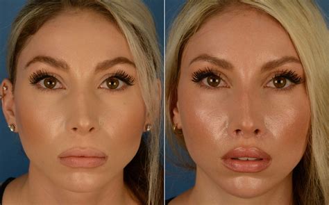 Lip Lift Photos Naples Fl Patient 14912