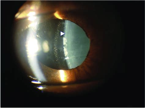 A Slit Lamp Photo Of The Right Eye On Postoperative Day After Icl