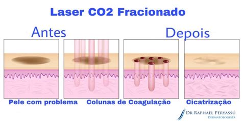 Laser De Co2 Fracionado Melhore Sua Pele Dr Raphael Peryassú