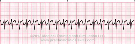 Ekg Practice Drill