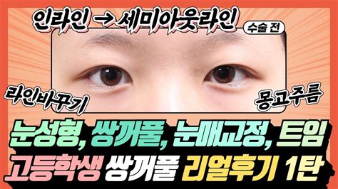 눈성형 쌍테 탈출👀 세미아웃을 원하던 고등학생의 쌍꺼풀 앞트임 눈매교정 리얼후기 1탄 Feat 눈성형 장인 눈성형