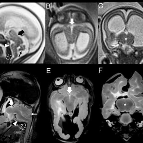 Fetal Brain MRI At 32 Gestational Weeks AC And Postnatal MRI