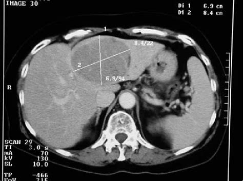 Figure From Tumor Seeding After Fine Needle Aspiration Biopsy And