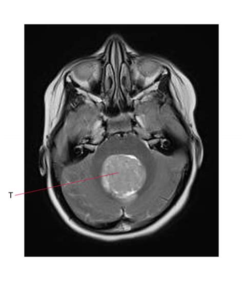 Tumor: Posterior Fossa Tumor