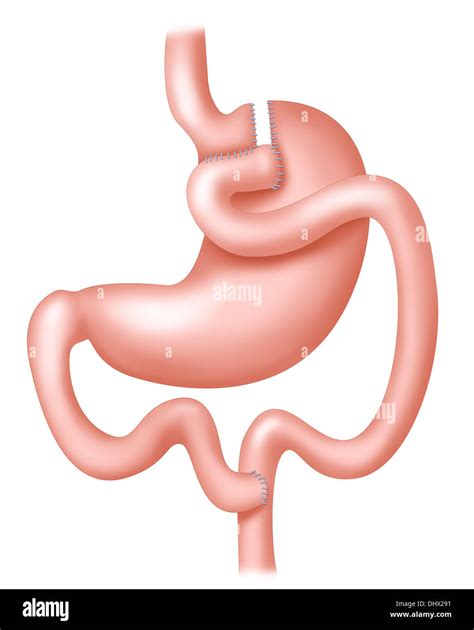 Roux En Y Bypass Gastrico Chirurgia Bariatrica Immagini E Fotografie