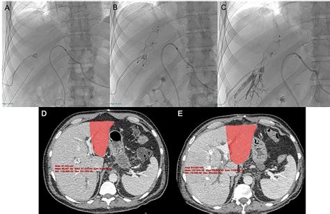 After Us Guided Percutaneous Transhepatic Access With Micropuncture