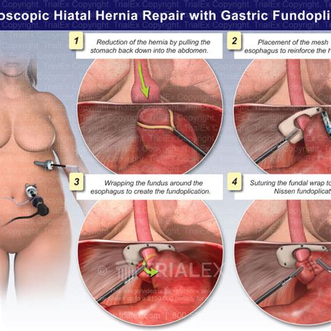 Laparoscopic Hiatal Hernia Repair With Gastric Fundoplication T