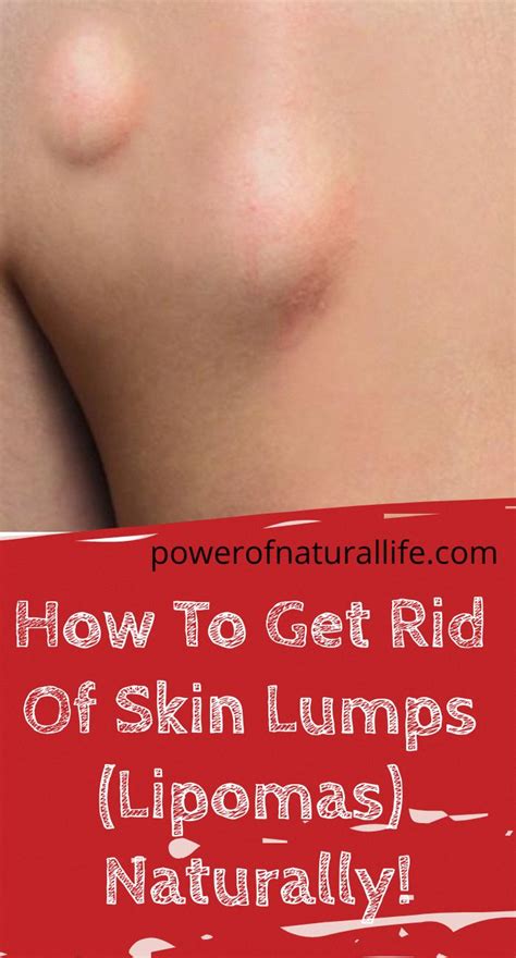 Get Rid Of Lump Behind Ear - get rid of bumps