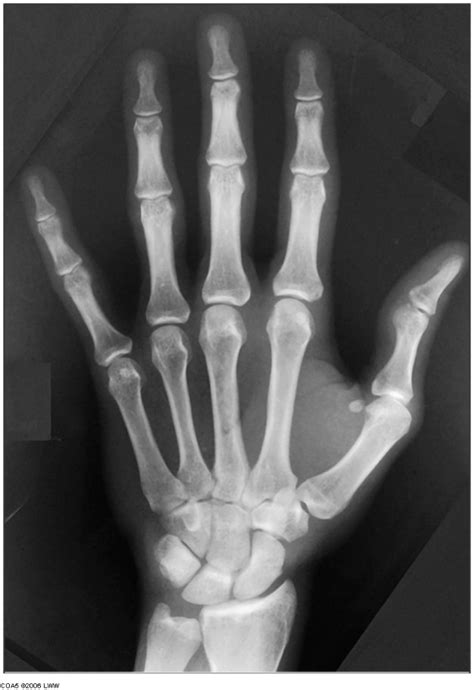 X RAY OF HAND Diagram | Quizlet