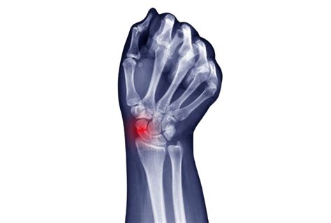 Scaphoid Fracture Manchester Hand Wrist Surgery