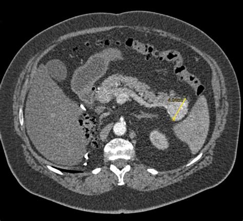 Vascular Metastases To The Pancreas From Renal Cell Carcinoma