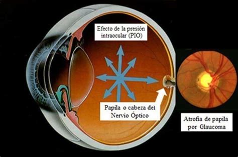 QuÉ Debo Saber Del Glaucoma Área Oftalmológica Avanzada