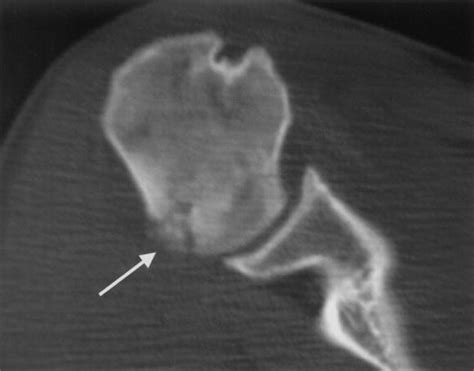 Intraarticular Osteoid Osteoma Of The Proximal Humerus A Case Report