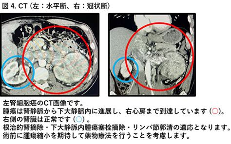 腎細胞がん 奈良県立医科大学 泌尿器科学教室 ホームページ