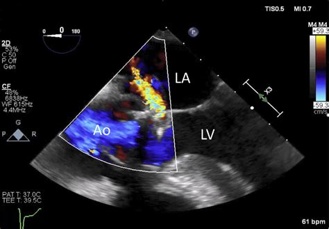 Transesophageal Echocardiography With Color Doppler Showing Left