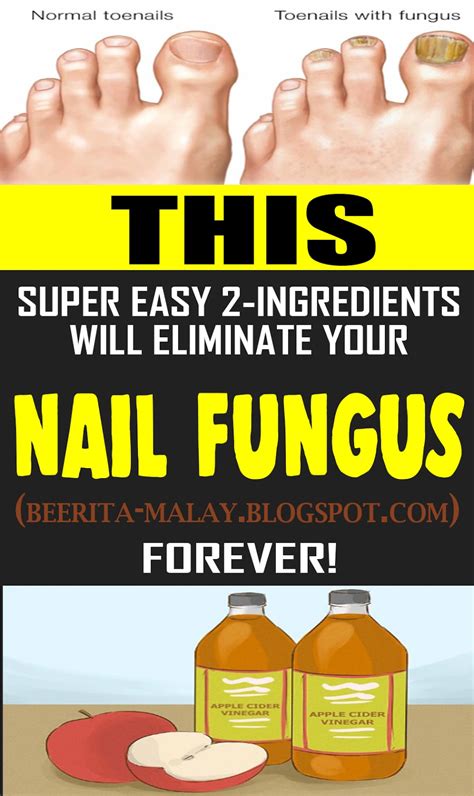 This Super Easy 2 Ingredient Recipe Will Eliminate Your Nail Fungus Forever