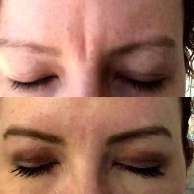 Botox Frown Lines Before And After Photos (1) » Facelift: Info, Prices ...