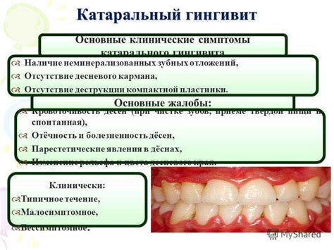 Гингивит