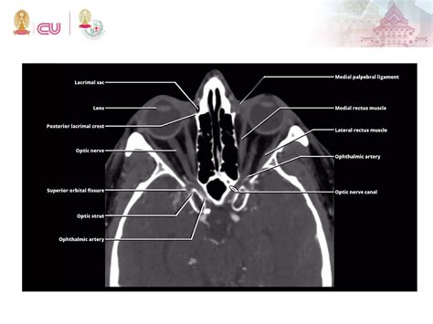 Surgical Anatomy Around The Orbit The System Of Zones A Continuation Of Surgical Anatomy Of The Orbit By Barry 9