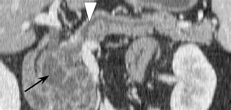 Macrocystic Neoplasms Of The Pancreas CT Differentiation Of Serous