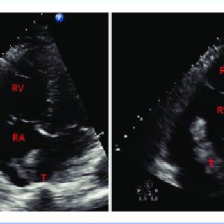 Transthoracic Echocardiogram RV Right Ventricle RA Right Atrium T