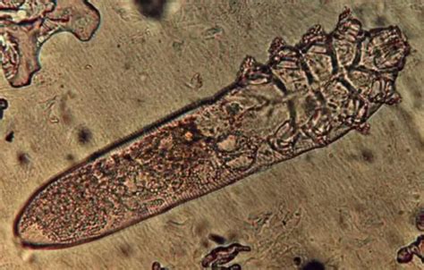 Demodex Folliculorum Symptoms Diagnosis Treatment Diseases And