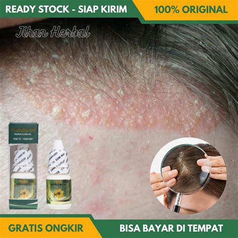 Jual Obat Kulit Kepala Kering Obat Kulit Kepala Gatal Obat Kulit