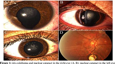 Coloboma Iris