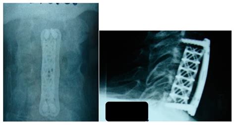 Jcm Free Full Text Cervical Spinal Epidural Abscess Diagnosis