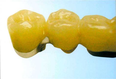 Окончательная обработка металлокерамической реставрации