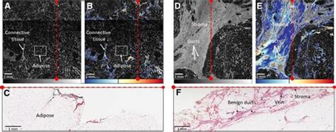 Diagnostic Accuracy Of Quantitative Micro Elastography For Margin Assessment In Breast