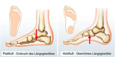 Kinder Plattfuß korrigierende Fuß Varus XO Fußgewölbe Einlegesohle