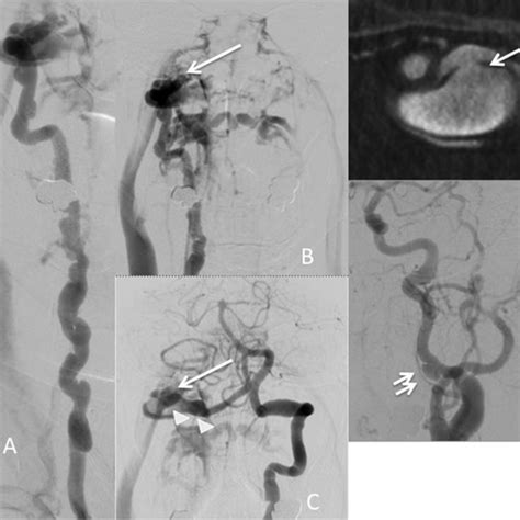 Postoperative Digital Subtraction Angiography A And B Right