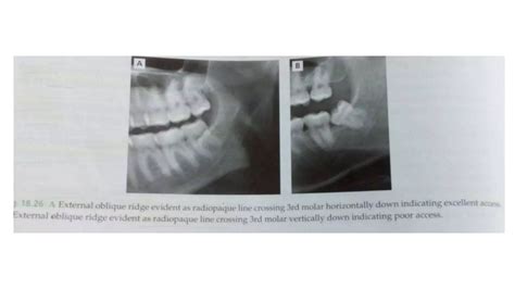 Radiographic Assessment Of Impacted Teeth Ppt