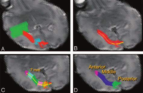 DTI fiber tracking and segmentation. A , DTI fiber tracks ( red ) were... | Download Scientific ...