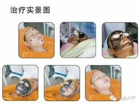 换季突然爆痘，我该怎么办？换季爆痘痘痘新浪女性新浪网